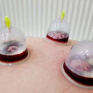 Kan Lipidi yüksek olan hastanın hacamat görüntüleri.