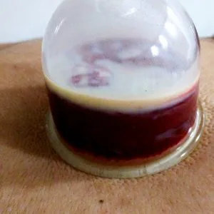 Kan Lipidi yüksek olan hastanın hacamat görüntüleri.