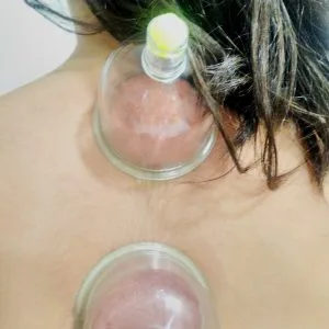 Çocuklara Hacamat Çocuklara Hacamat